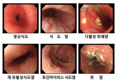 위내시경사진