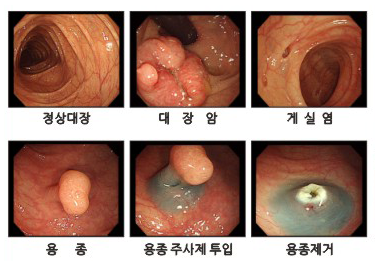 대장내시경사진