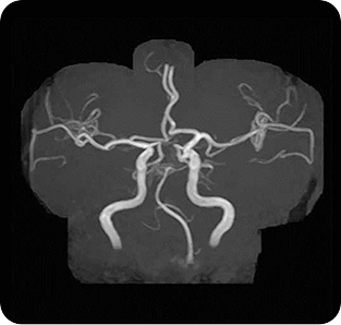 <기존 MRI 뇌혈관 영상>