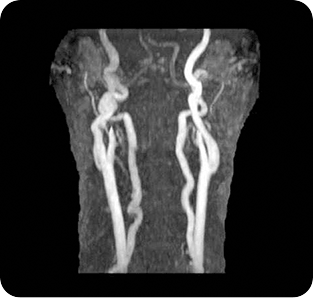 <기존 MRI 경동맥 영상>